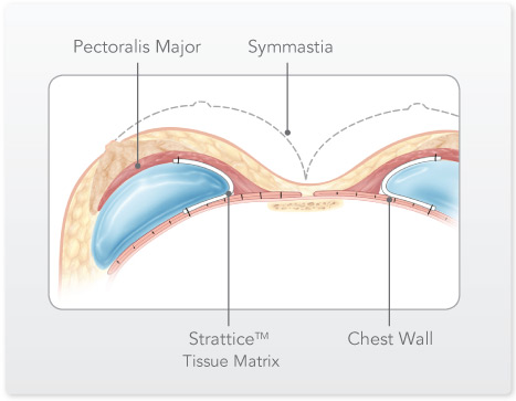 Strattice What Is Symmastia Repair? – Symmastia: Causes, Signs, Symptoms, and ...