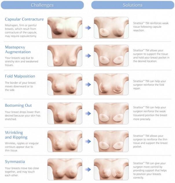 Cosmetic Breast Surgery