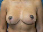 Breast Revision with Strattice: Patient #3 after