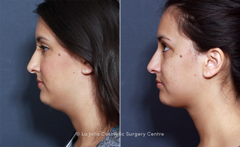 Picture of facial liposuction Can defined? picture of facial liposuction