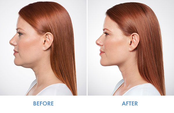 ljcsc-kybella-banda_adra-01