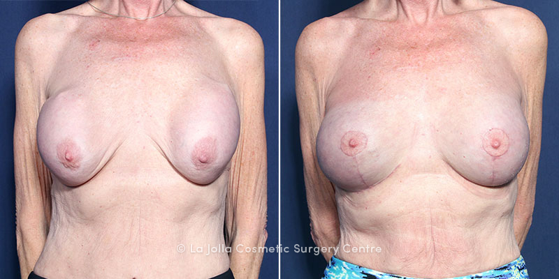 Results of a breast capsulectomy surgery