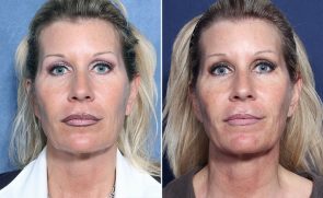 thermitight patient roark ljcsc face skin patients diego san
