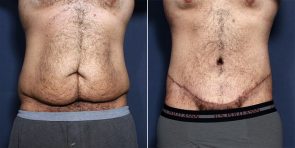 tummy tuck before male abdominoplasty patient diego san ljcsc favs