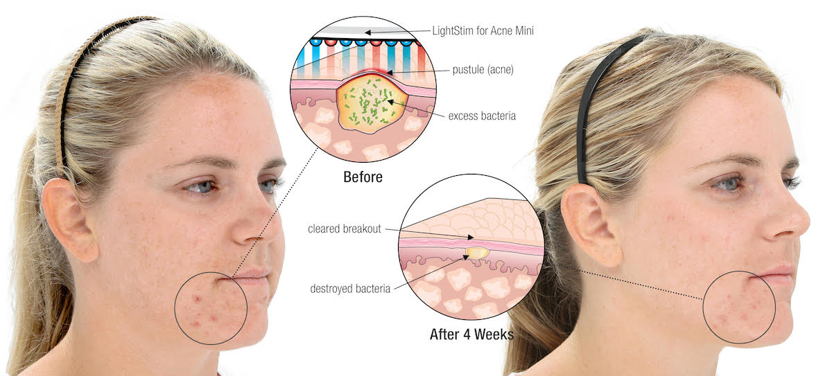 lightstim before and after photos