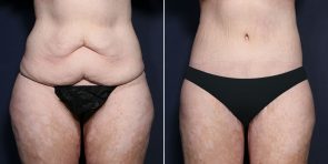 tuck tummy before lift favs patient