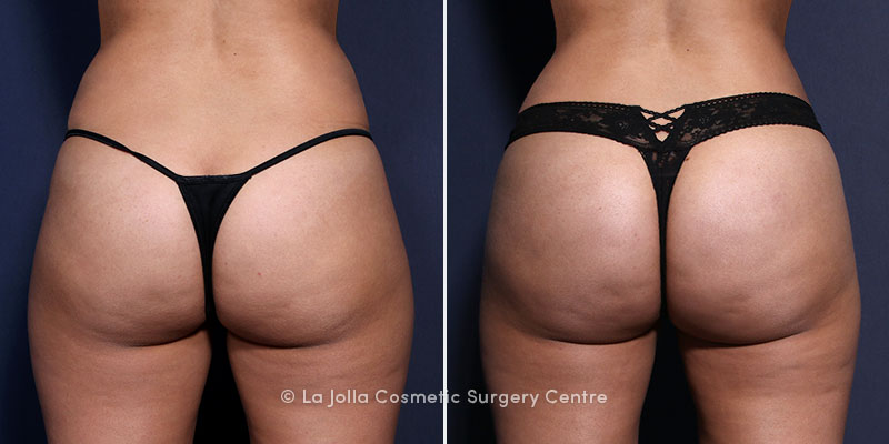 san diego brazilian butt lift before and after san diego brazilian butt lift before and after