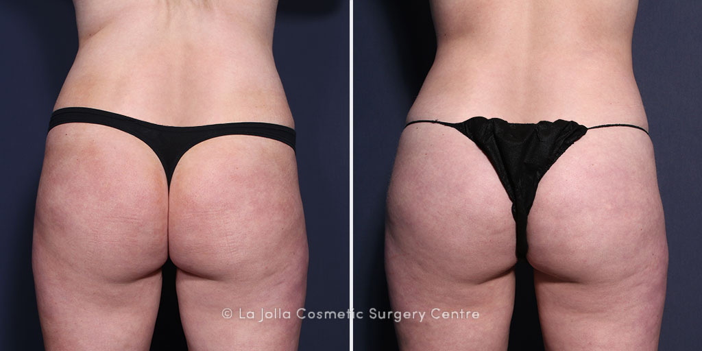 la jolla brazilian butt lift before and after la jolla brazilian butt lift before and after