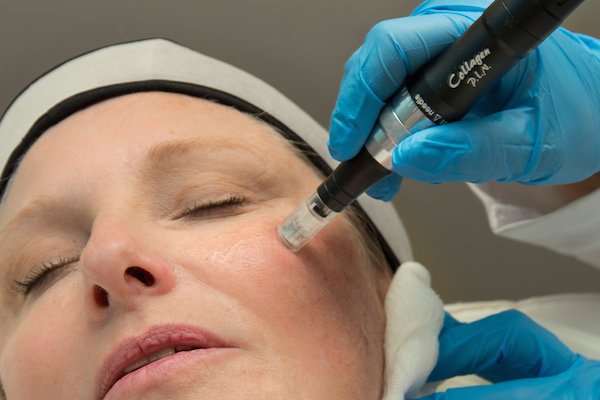 woman receiving microneedling anti-aging treatment with collagen pin